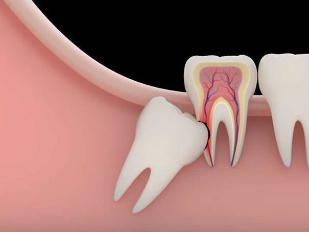 Nhổ răng số 8 - Có nên nhổ bỏ hay giữ lại, vì sao? 1